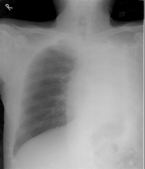白肺X光片